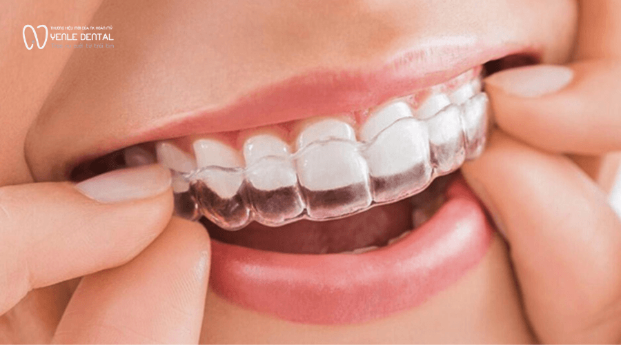 Niềng răng Invisalign